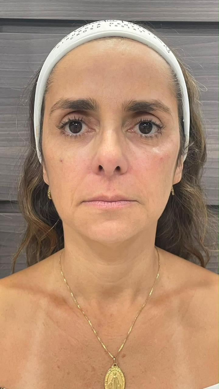 Caso 03 — depois